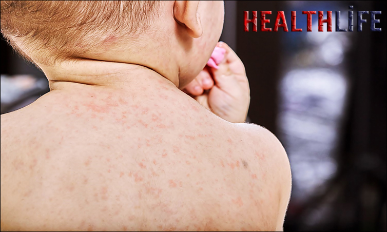 Can A Child With Roseola Take A Bath