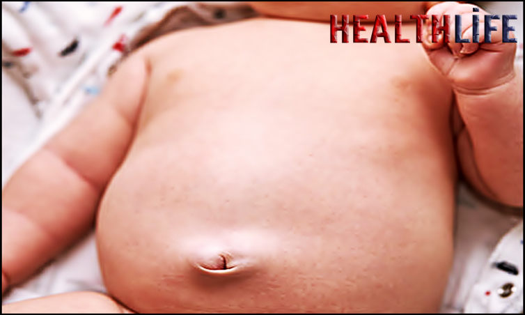 Does Umbilical Hernia Cause Pain In Babies