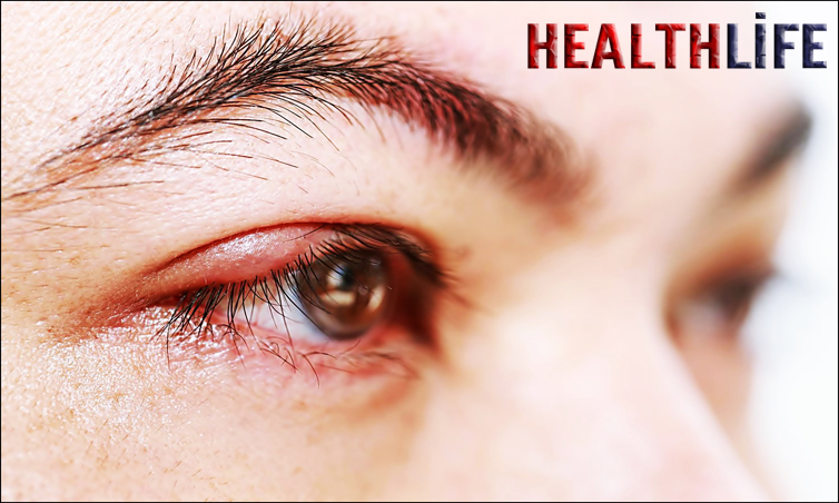 How Do I Get Rid Of A Stye Overnight
