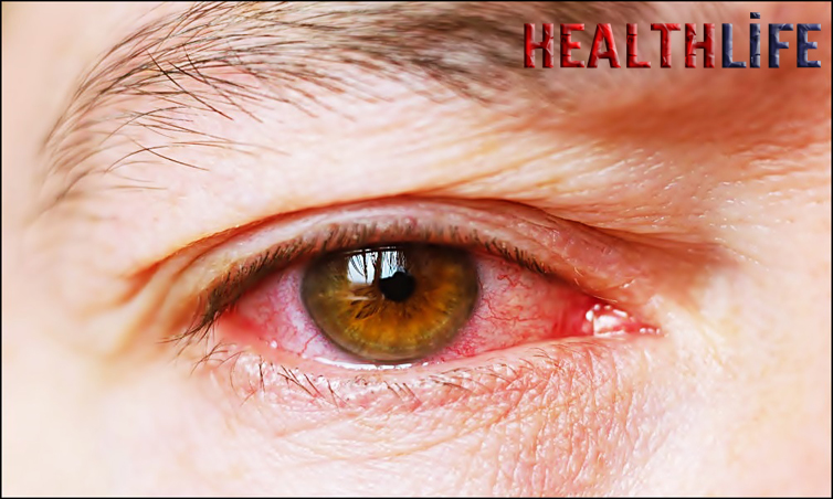 How Do You Know If You Have Uveitis