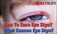 How To Cure Eye Stye
