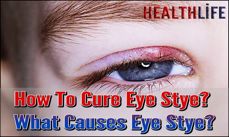 How To Cure Eye Stye