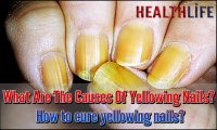 What Are The Causes Of Yellowing Nails