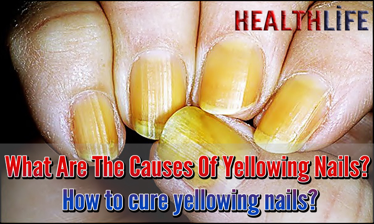 What Are The Causes Of Yellowing Nails
