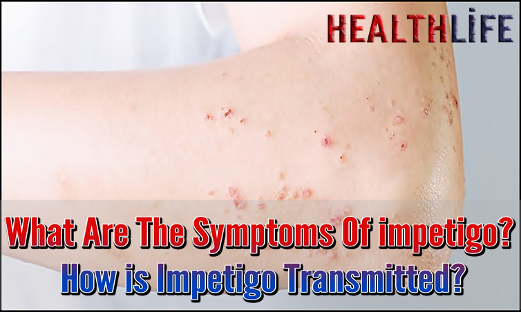 What Are The Symptoms Of impetigo