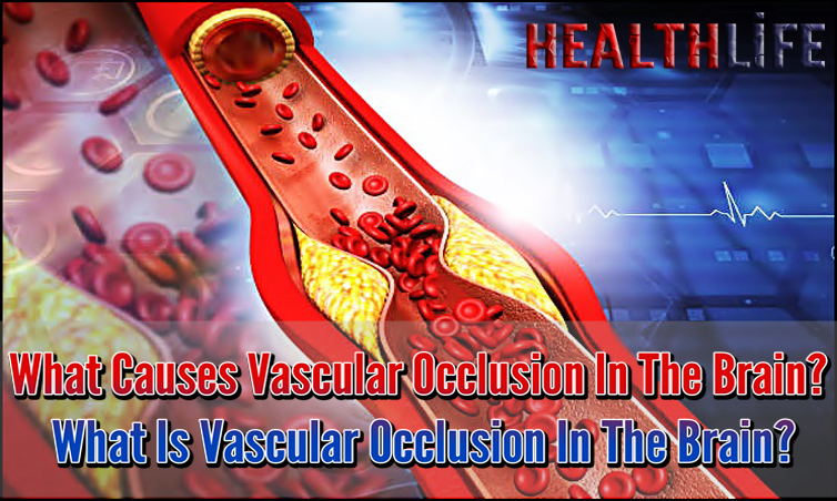 What Causes Vascular Occlusion In The Brain