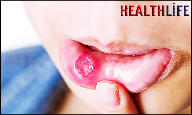 What Causes Wound In The Lips
