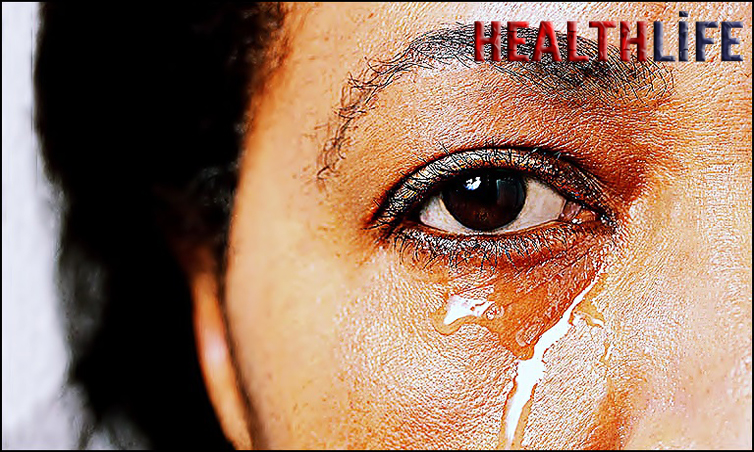 What Is A Natural Remedy For Watery Eyes