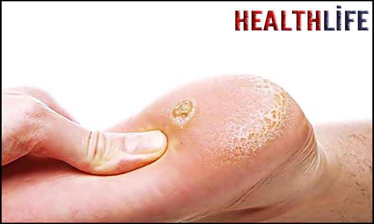What Is The Best Treatment For Hyperkeratosis