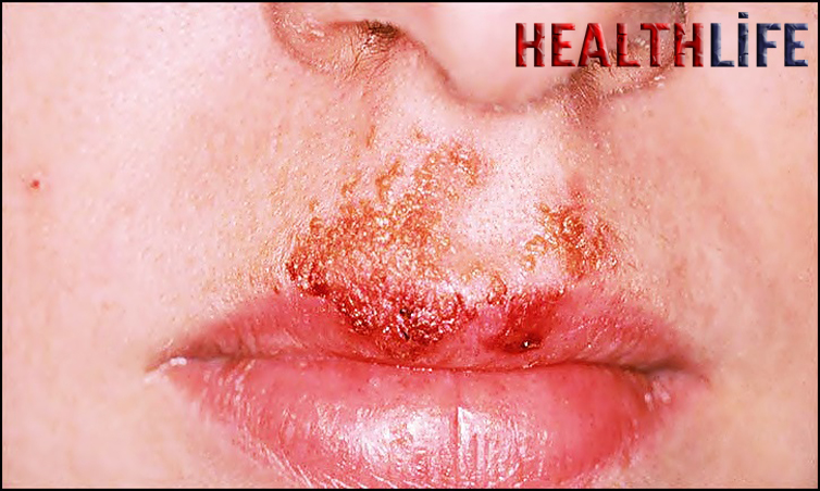 What Is The Fastest Way To Cure Impetigo