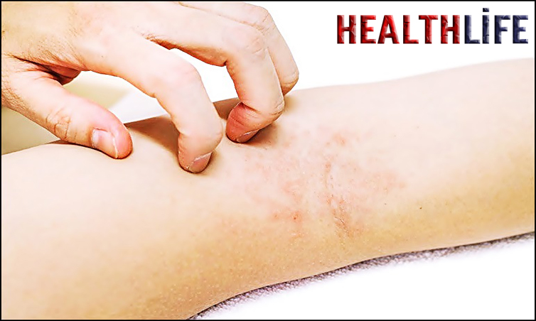 What Triggers A Flare Up With Sarcoidosis