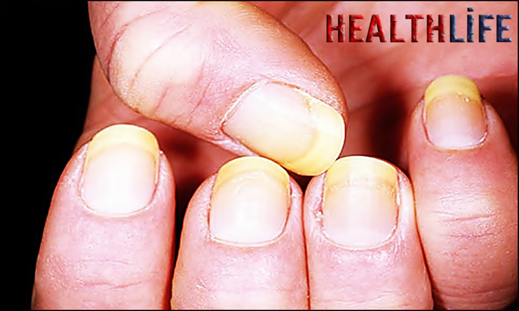 What Vitamin Deficiency Causes Yellow Nails