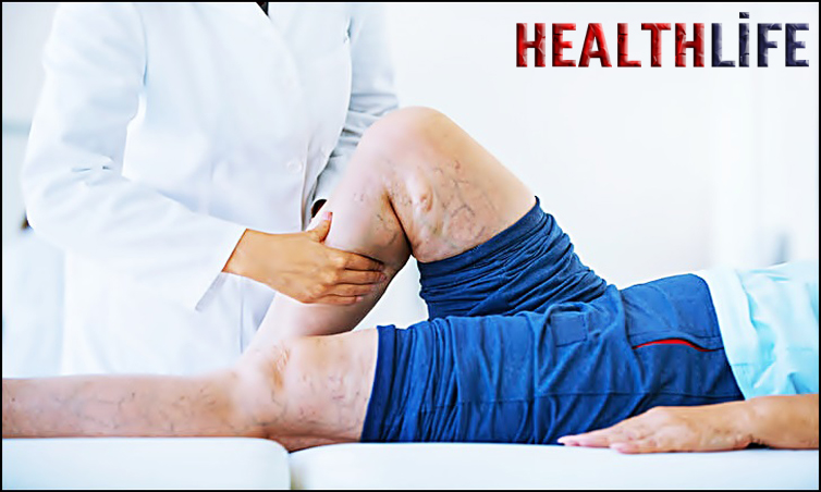 How Do I Stop Fluid Build Up In My Knees
