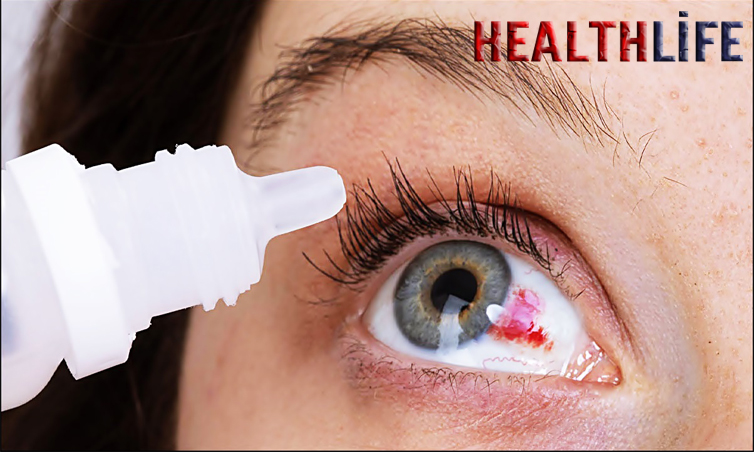 How Do You Heal A Bleeding Eye