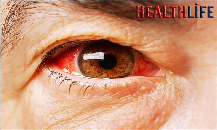 How Long Do Bloodshot Eyes Last