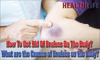 How To Get Rid Of Bruises On The Body