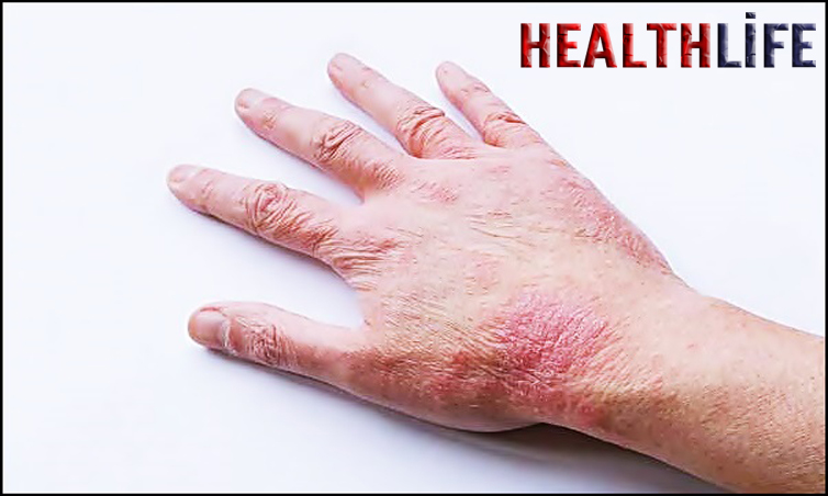 How To Get Rid Of Hand Eczema