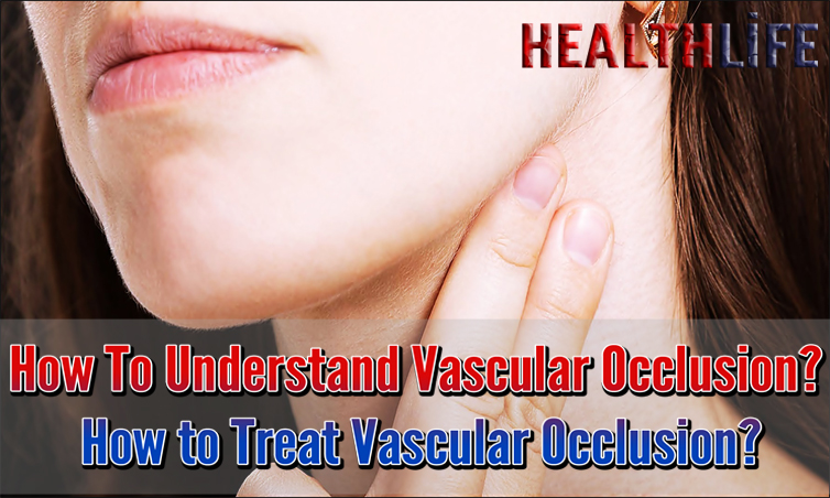 How To Understand Vascular Occlusion