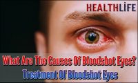 What Are The Causes Of Bloodshot Eyes