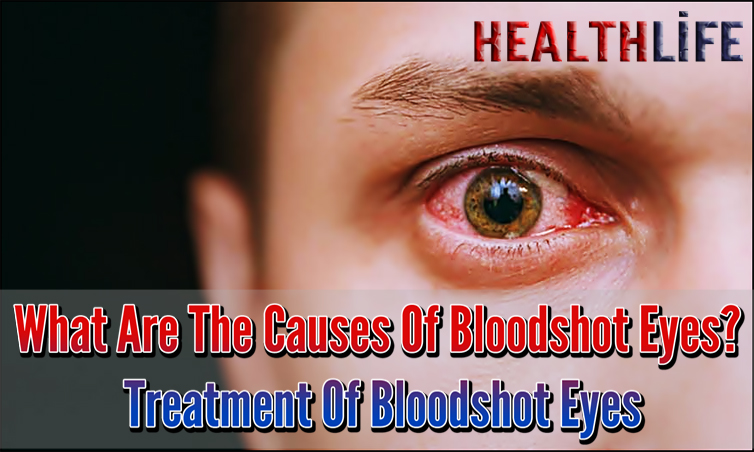 What Are The Causes Of Bloodshot Eyes