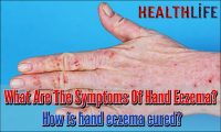 What Are The Symptoms Of Hand Eczema