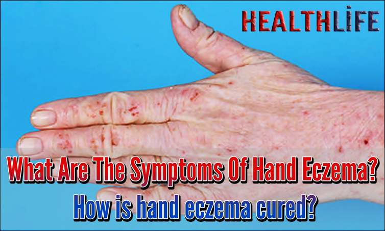 What Are The Symptoms Of Hand Eczema
