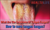 What Are The Symptoms Of Tongue Fungus