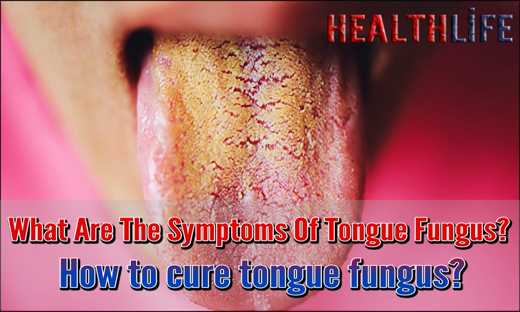 What Are The Symptoms Of Tongue Fungus