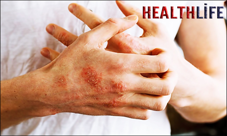 What Are The Three Types Of Latex Allergies