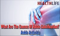 What Causes Calcification In The Ankle