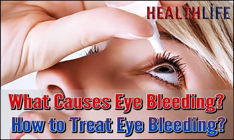 What Causes Eye Bleeding