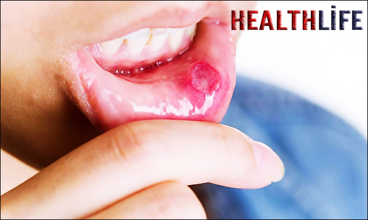What Causes Fungal Tongue