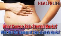 What Causes Skin Stretch Marks
