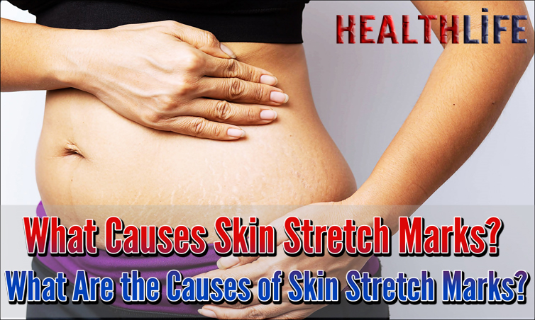 What Causes Skin Stretch Marks