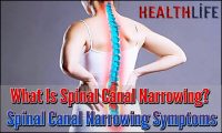 What Is Spinal Canal Narrowing
