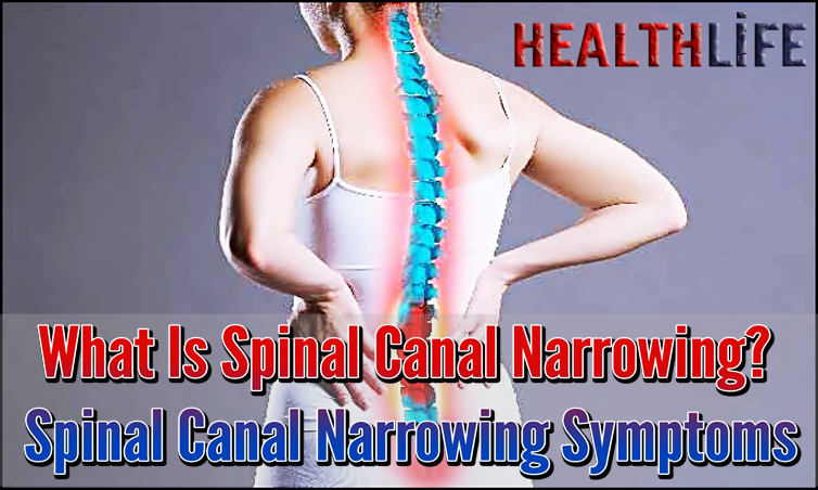 What Is Spinal Canal Narrowing