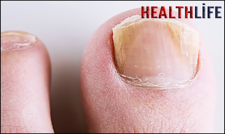 How Do You Treat An Inflamed Fingernail