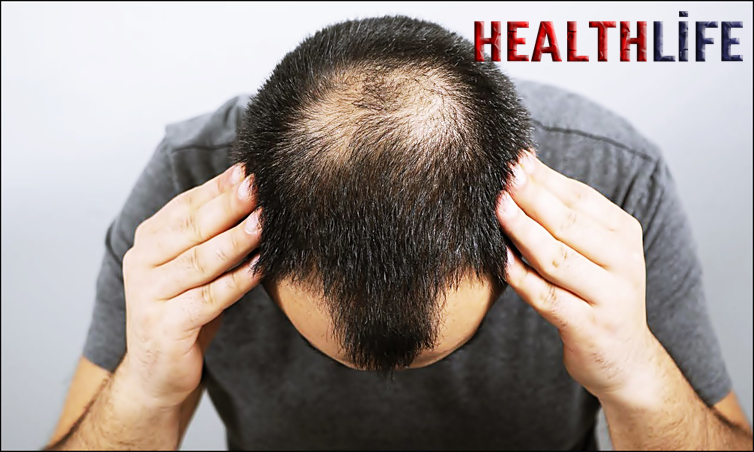 How Do You Take Care Of A Prosthetic Hair