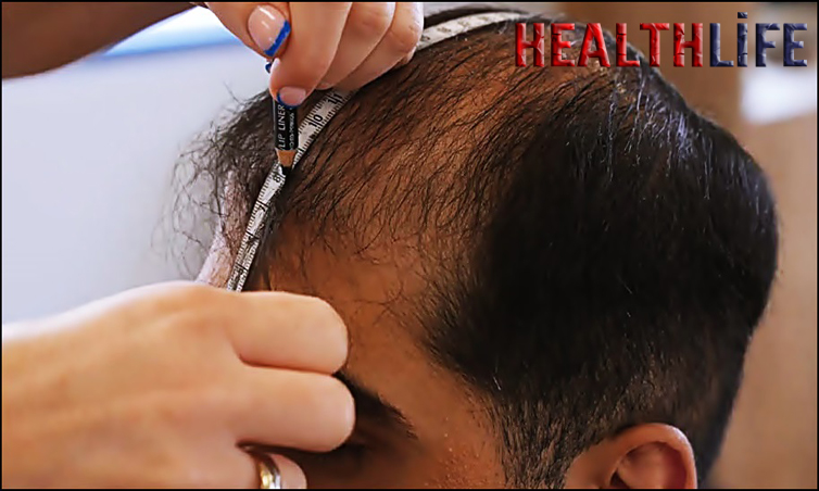 How Do You Take Care Of Prosthetic Hair
