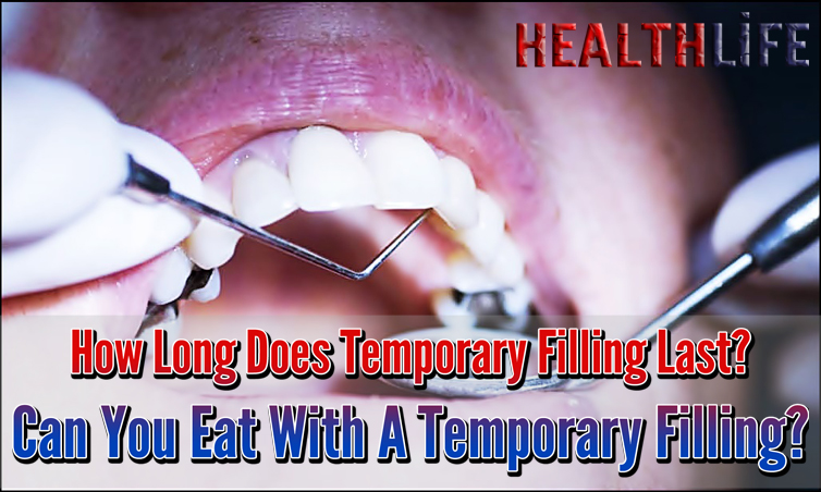 How Long Does Temporary Filling Last