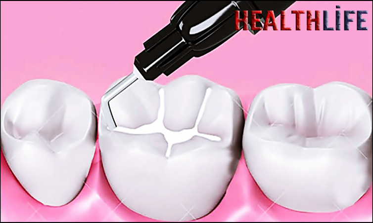 Are Fissure Sealants Permanent