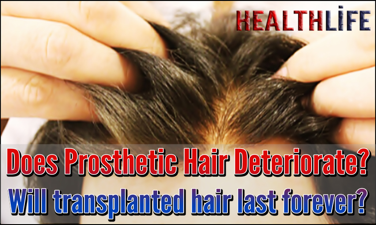 Does Prosthetic Hair Deteriorate