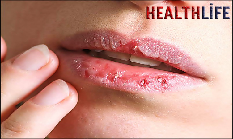How Do I Stop My Lips From Cracking