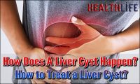 How Does A Liver Cyst Happen