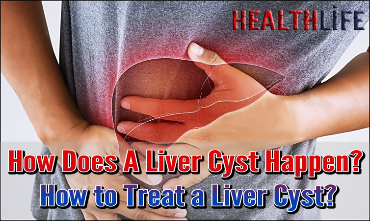 How Does A Liver Cyst Happen