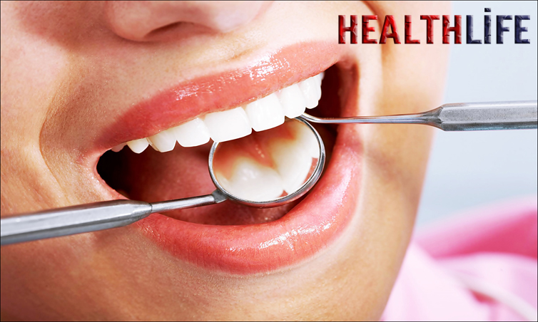 How Long Do Fillings Last On Front Teeth