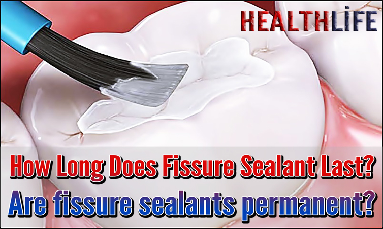 How Long Does Fissure Sealant Last