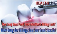 How Long Does Front Teeth Aesthetic Filling Last