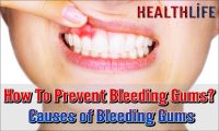 How To Prevent Bleeding Gums