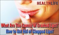 What Are The Causes Of Cracked Lips